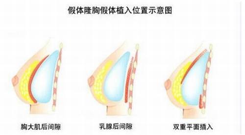 假体丰胸影响哺乳吗？   爱颜网