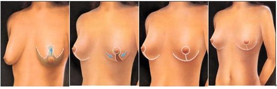 女性乳房下垂该怎么矫正