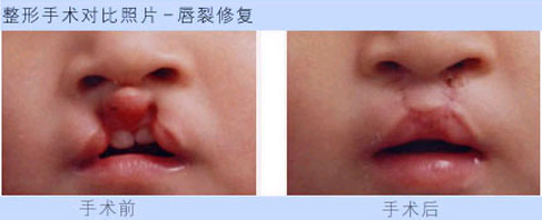兔唇可以治疗好吗