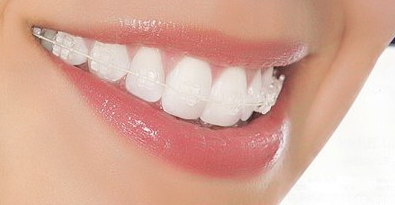 牙齿矫正后应该怎样护理